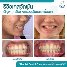 เคสรีวิว