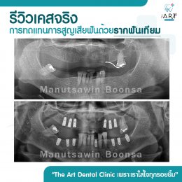 เคสรีวิว