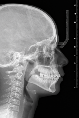 X-ray และ CBCT จำเป็นแค่ไหน ในคนนอนกรนหรือ OSA?