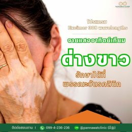 ฉายแสงรักษาโรคด่างขาว 