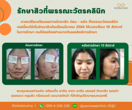 รักษาสิวที่พรรณะวัตรคลินิก