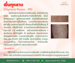 "ผื่นกุหลาบ" (Pityriasis Rosea – PR)