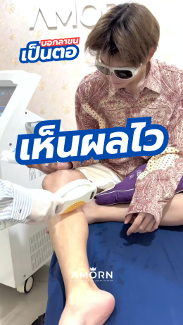 เลเซอร์กำจัดขน