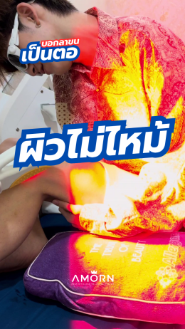 เลเซอร์กำจัดขน