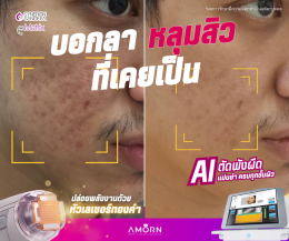 หลุมสิว