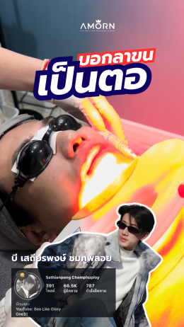 เลเซอร์กำจัดขน