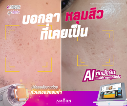 รักษาหลุมสิว