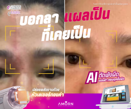 eMatrixTWO | รักษาแผลเป็นหลุมสิว แผลเป็น โดยเฉพาะ