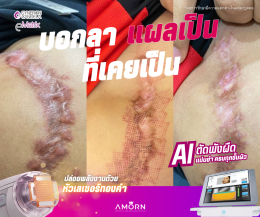 รักษาแผลเป็น