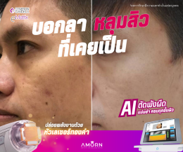 eMatrixTWO | รักษาแผลเป็นหลุมสิว แผลเป็น โดยเฉพาะ