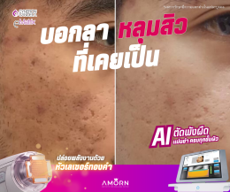 eMatrixTWO | รักษาแผลเป็นหลุมสิว แผลเป็น โดยเฉพาะ