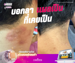 รักษาแผลเป็น