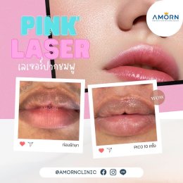 Pink Lip Laser เลเซอร์ลดความคล้ำปาก 