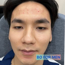 ฺBotulinum Toxin | ที่สุดของ “การลดริ้วรอย” 