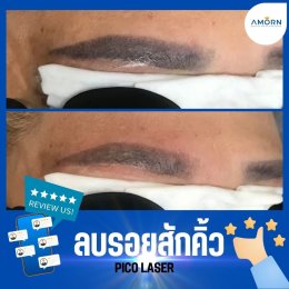 ลบรอยสัก