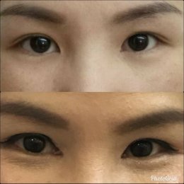 medialcanthoplasty1