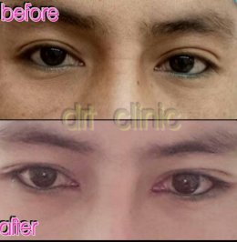 medialcanthoplasty1