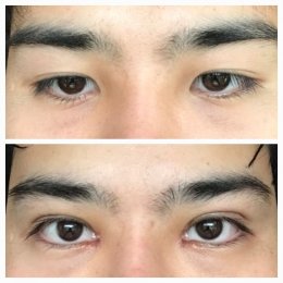 medialcanthoplasty1