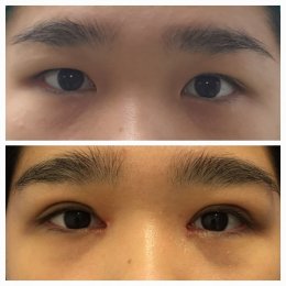 medialcanthoplasty1