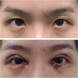 medialcanthoplasty1