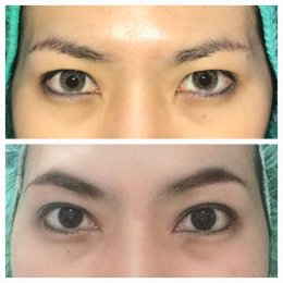 medialcanthoplasty1