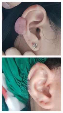 earkeloid