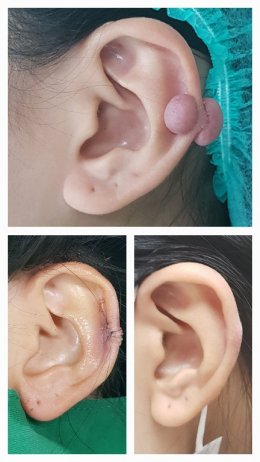 earkeloid