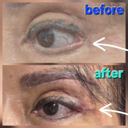 lateralcanthoplasaty