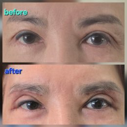 lateralcanthoplasaty