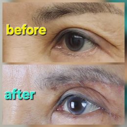 lateralcanthoplasaty