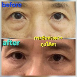 lateralcanthoplasaty