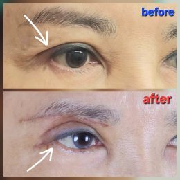 lateralcanthoplasaty