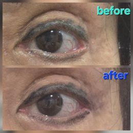 lateralcanthoplasaty