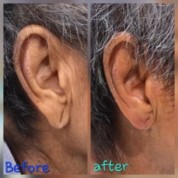 earlobe reduction