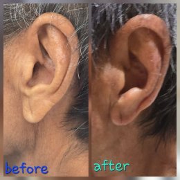 earlobe reduction
