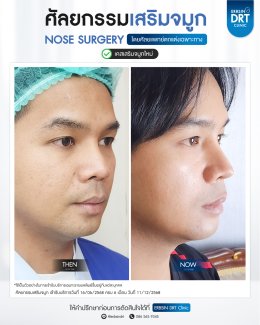 ศัลยกรรมจมูก