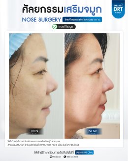 ศัลยกรรมจมูก