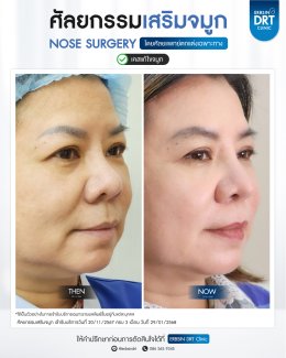 ศัลยกรรมจมูก