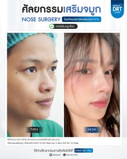 ศัลยกรรมจมูก