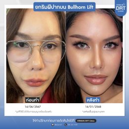 รีวิวศัลยกรรมยกริมฝีปาก BULLHORN