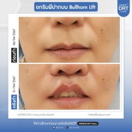 รีวิวศัลยกรรมยกริมฝีปาก BULLHORN