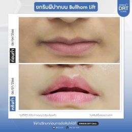 รีวิวศัลยกรรมยกริมฝีปาก BULLHORN