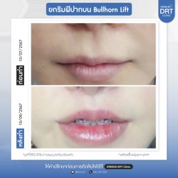 รีวิวศัลยกรรมยกริมฝีปาก BULLHORN