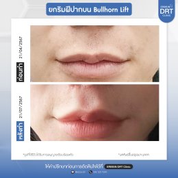 รีวิวศัลยกรรมยกริมฝีปาก BULLHORN
