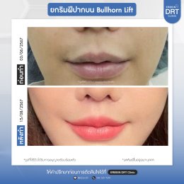 รีวิวศัลยกรรมยกริมฝีปาก BULLHORN