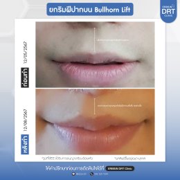 รีวิวศัลยกรรมยกริมฝีปาก BULLHORN