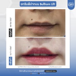 รีวิวศัลยกรรมยกริมฝีปาก BULLHORN