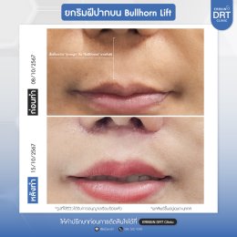 รีวิวศัลยกรรมยกริมฝีปาก BULLHORN