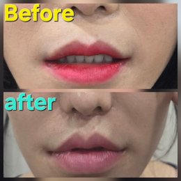 lipcornerlift