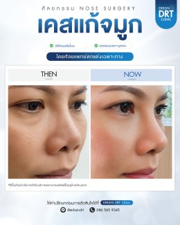 Review Nose Silicone
